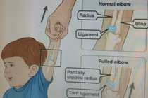 Trật khớp vì kéo trẻ một tay