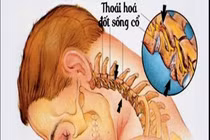 Giảm đau và phục hồi thoát vị, thoái hóa cột sống