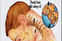 Giảm đau và phục hồi thoát vị, thoái hóa cột sống