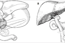 Triệu chứng u nang đường mật