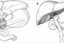 Triệu chứng u nang đường mật