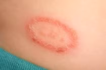 Thuốc Nam chữa hắc lào 