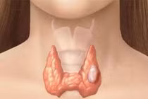 Các giai đoạn ung thư tuyến giáp 