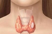 Các giai đoạn ung thư tuyến giáp 