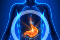 Liệt dạ dày do biến chứng đái tháo đường