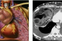 U chèn ép trung thất rất nguy hiểm