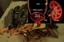 Bài thuốc đơn giản phòng chống sỏi đường tiết niệu mùa hè