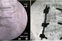 Lưu ý khi phẫu thuật cột sống ở người trẻ 
