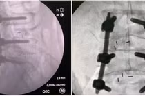 Lưu ý khi phẫu thuật cột sống ở người trẻ 