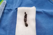 Đỉa chui đường hô hấp 