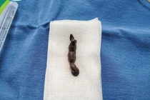 Đỉa chui đường hô hấp 