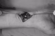 Đứt gân tay do vật nuôi tấn công