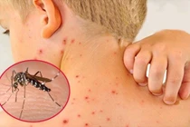 Bệnh sốt xuất huyết: Nguyên nhân và cách cải thiện hiệu quả