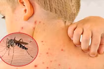 Bệnh sốt xuất huyết: Nguyên nhân và cách cải thiện hiệu quả