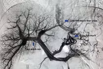 Can thiệp TIPS cứu bệnh nhân vỡ tĩnh mạch thực quản