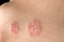 Phương pháp hỗ trợ điều trị vảy nến không dùng thuốc hiệu quả hiện nay