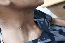 Cụ ông 61 tuổi bị hóc xương cá xuyên từ thực quản ra cổ