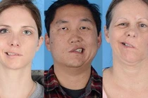 Liệt mặt do chạy xe không che gió