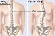 Cảnh giác với vẹo cột sống ở trẻ em
