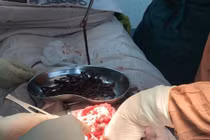 Tổn thương dạ dày vì hội chứng thích ăn dị vật kim loại 