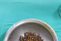 Hãi hùng 400 viên sỏi ken chặt trong túi mật