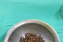Hãi hùng 400 viên sỏi ken chặt trong túi mật