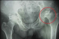 Hoại tử chỏm xương đùi do uống rượu và hút thuốc lá