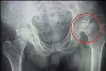 Hoại tử chỏm xương đùi do uống rượu và hút thuốc lá