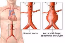 Biến chứng của phình động mạch chủ bụng