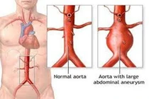 Biến chứng của phình động mạch chủ bụng