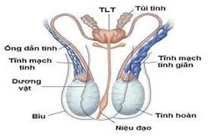 Xử lý giãn tĩnh mạch tinh