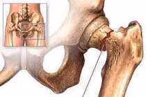 Điều trị gãy xương sau thay khớp háng