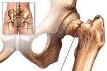 Điều trị gãy xương sau thay khớp háng