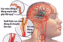 Thảo dược phòng chữa xuất huyết não