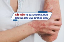 Vảy nến và các phương pháp điều trị hiệu quả từ thảo dược