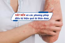 Vảy nến và các phương pháp điều trị hiệu quả từ thảo dược