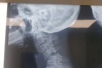 Cứu bệnh nhân gãy trật cột sống cổ 