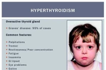 Điều trị I-131 cho trẻ bị Basedow