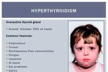 Điều trị I-131 cho trẻ bị Basedow