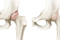 Cố chịu đau dẫn tới phải thay khớp háng