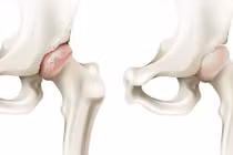 Cố chịu đau dẫn tới phải thay khớp háng