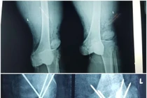  Trắng đêm để cứu chân dập nát của tài xế