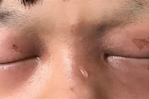  Cẩn thận chấn thương mắt do hỏa khí