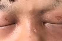  Cẩn thận chấn thương mắt do hỏa khí