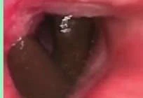 Ho ra máu vì đỉa chui khí quản