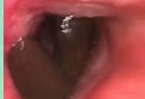 Ho ra máu vì đỉa chui khí quản