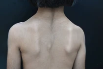 Phát hiện bệnh di truyền hiếm gặp: Hội chứng Cantú