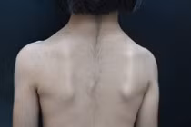 Phát hiện bệnh di truyền hiếm gặp: Hội chứng Cantú