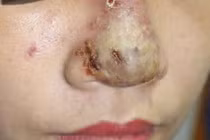 Ổ mủ mũi sau khi tiêm Filler