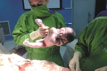 Kỹ thuật cứu sống sản phụ nguy kịch vì hellp